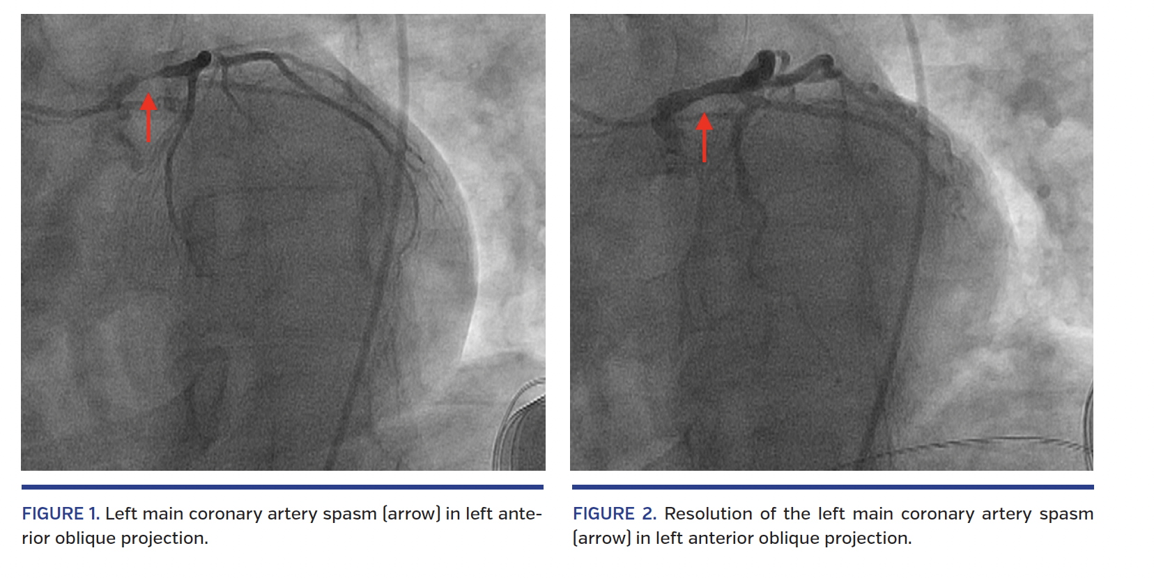 FIGURE 1. Left main coronary artery spasm