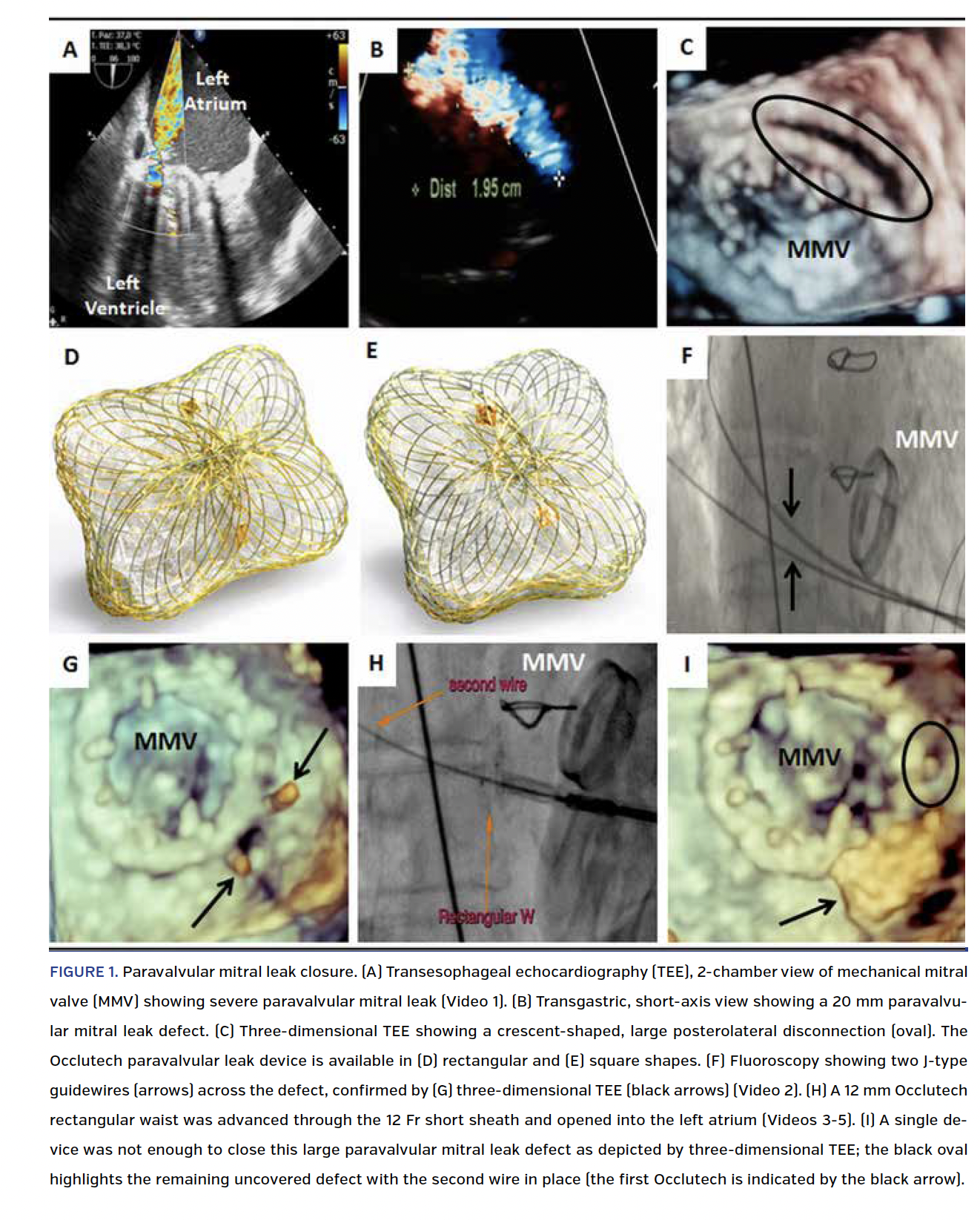 FIGURE 1. Paravalvular mitral leak closure..png
