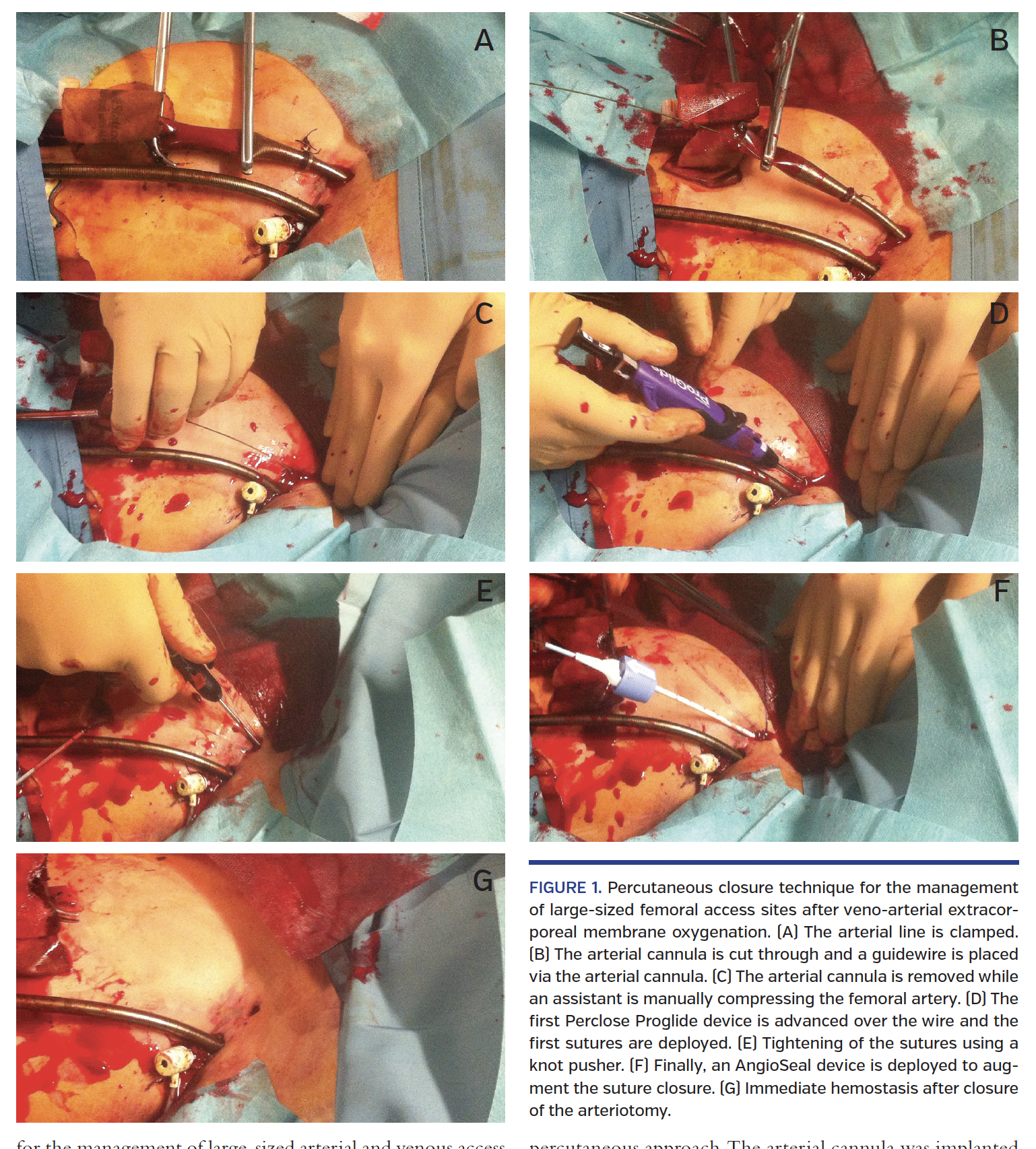 FIGURE 1. Percutaneous closure technique.png