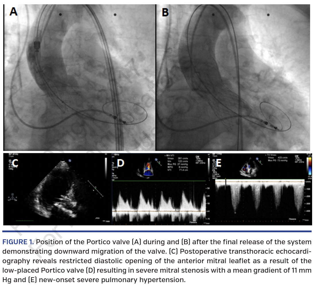 FIGURE 1. Position of the Portico valve 