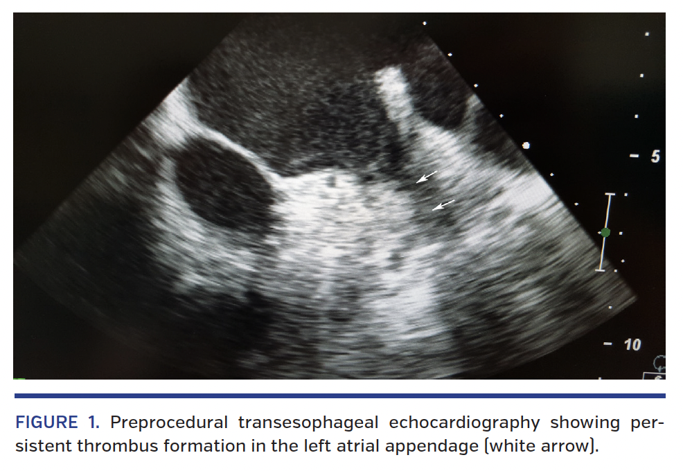 FIGURE 1. Preprocedural transesophageal echocardiography.png
