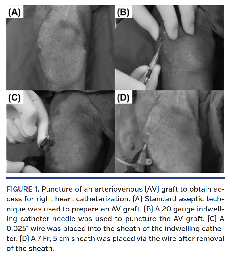 FIGURE 1. Puncture of an arteriovenous.png