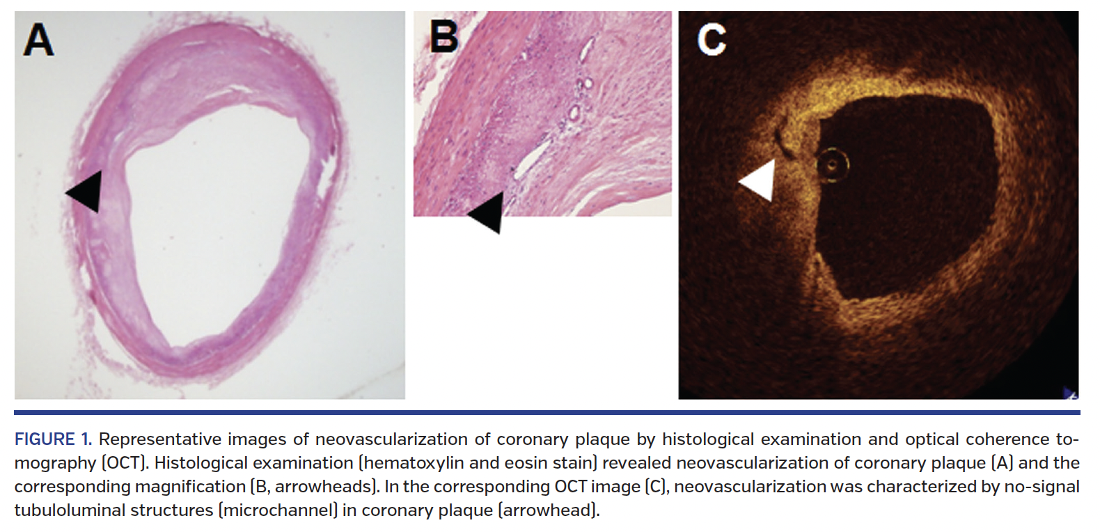 FIGURE 1. Representative images of neovascularization of coronary plaque.png