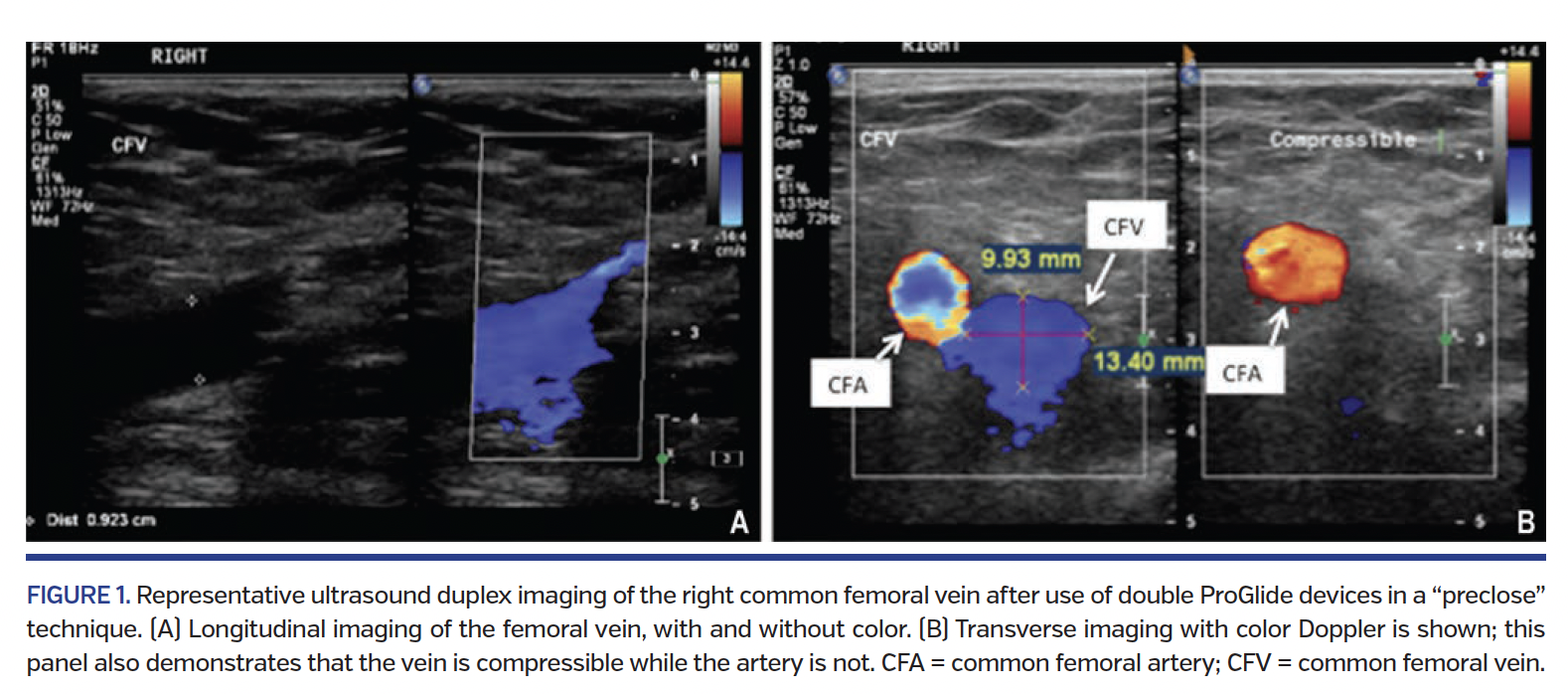 FIGURE 1. Representative ultrasound duplex imaging.png