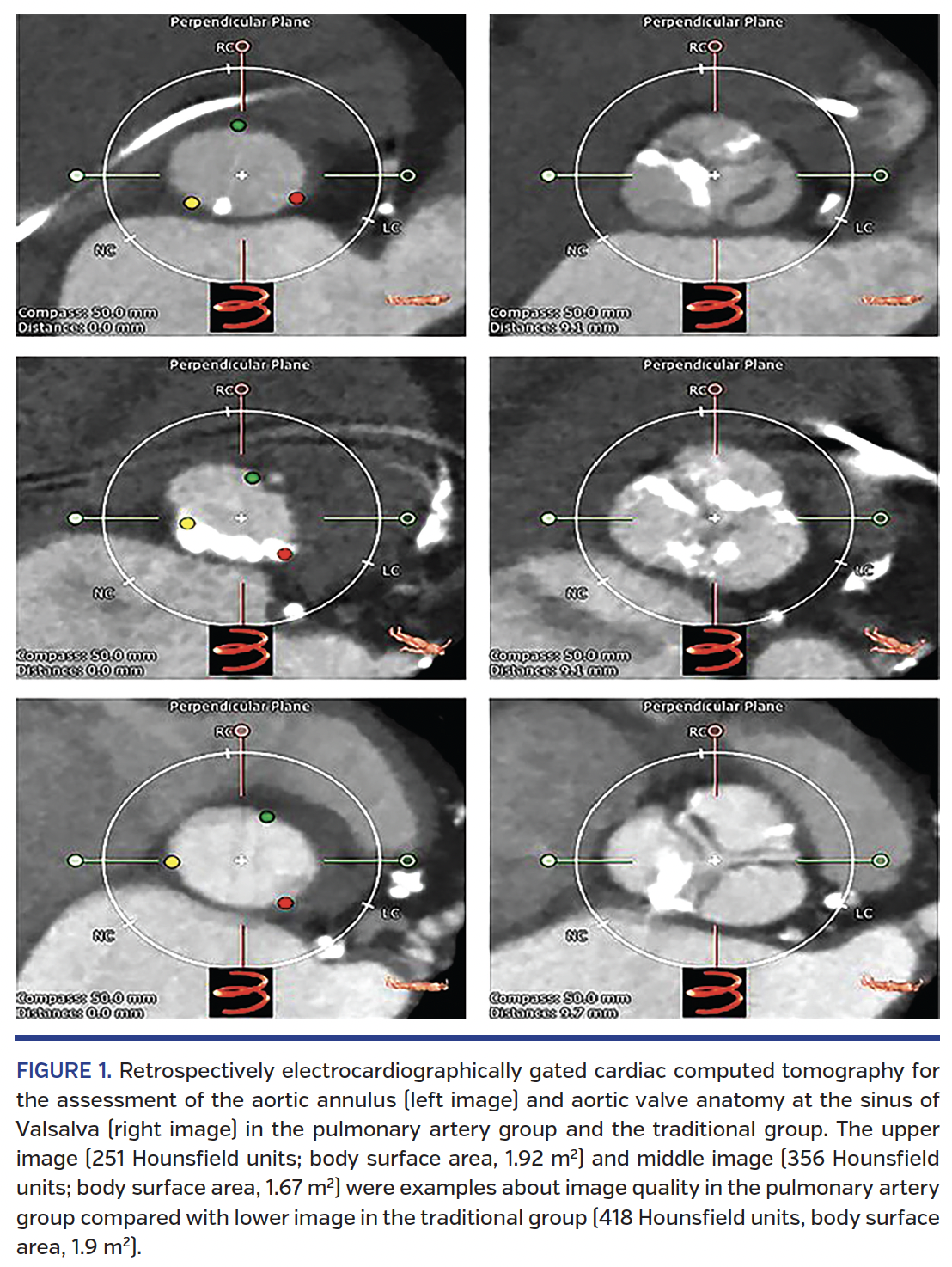 FIGURE 1. Retrospectively electrocardiographically gated cardiac computed tomography.png
