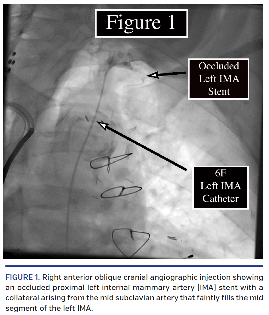 FIGURE 1. Right anterior oblique cranial angiographic injection.png
