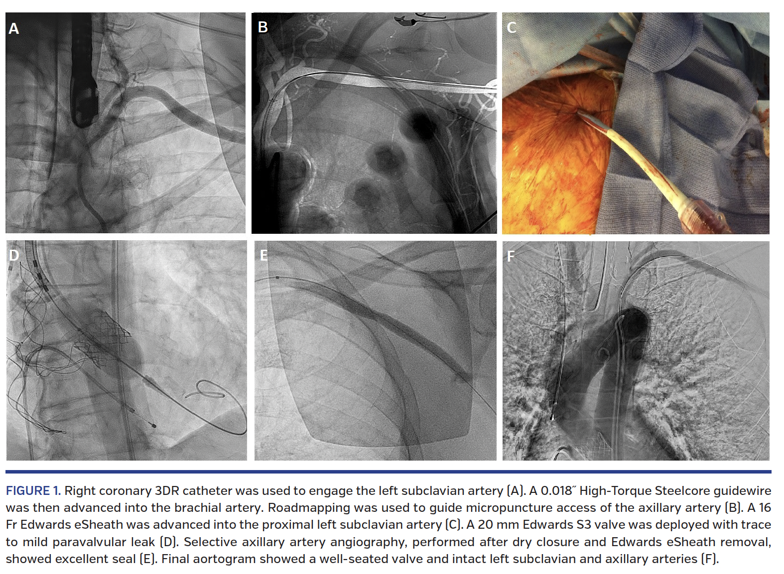 FIGURE 1. Right coronary 3DR catheter