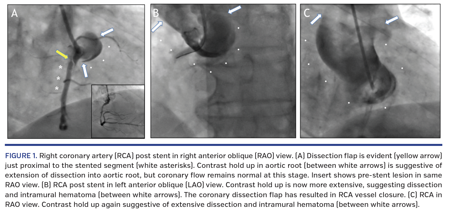FIGURE 1. (D) RCA post rewiring and salvage stent.png