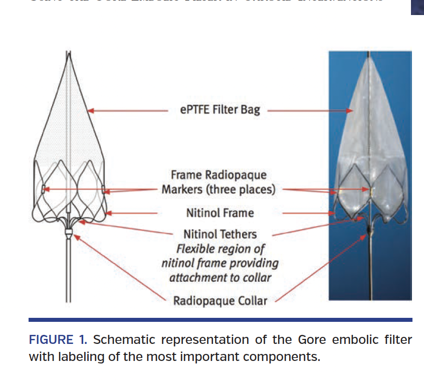 FIGURE 1. Schematic representation of the Gore embolic filter.png