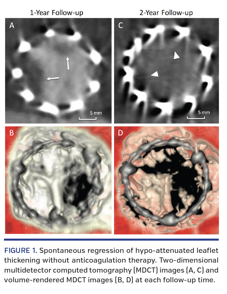 FIGURE 1. Spontaneous regression of hypo-attenuated leaflet