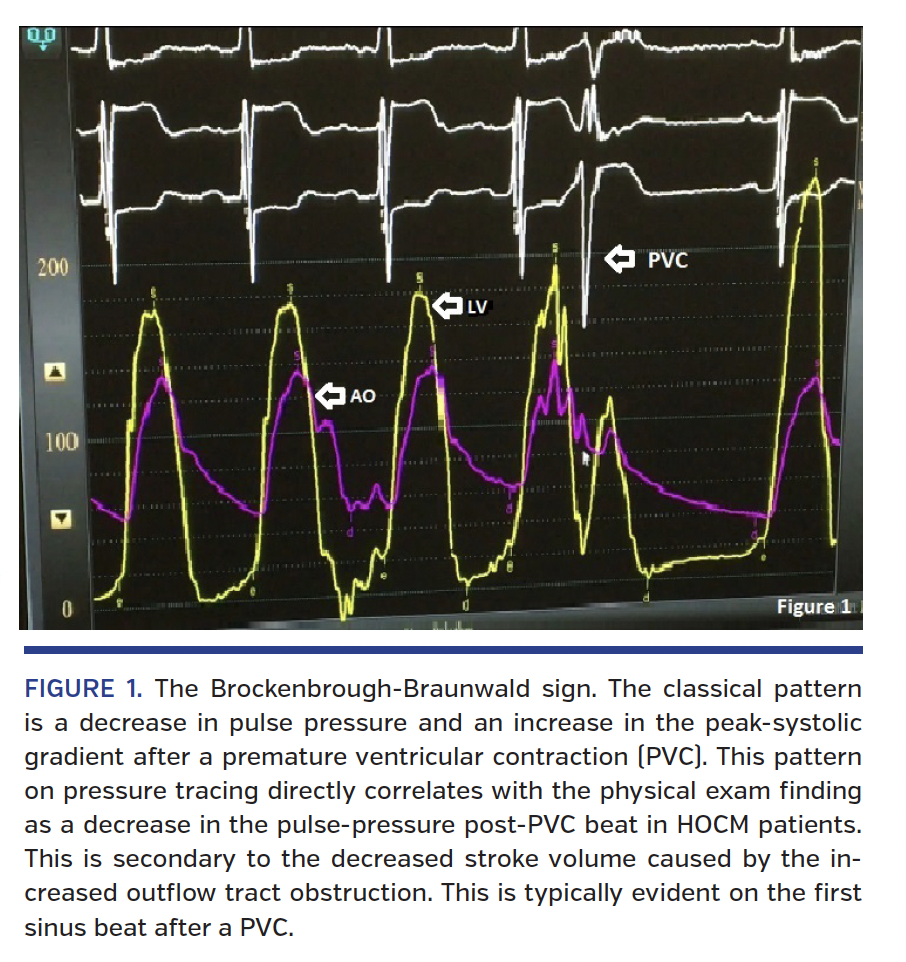 FIGURE 1. The Brockenbrough-Braunwald sign.