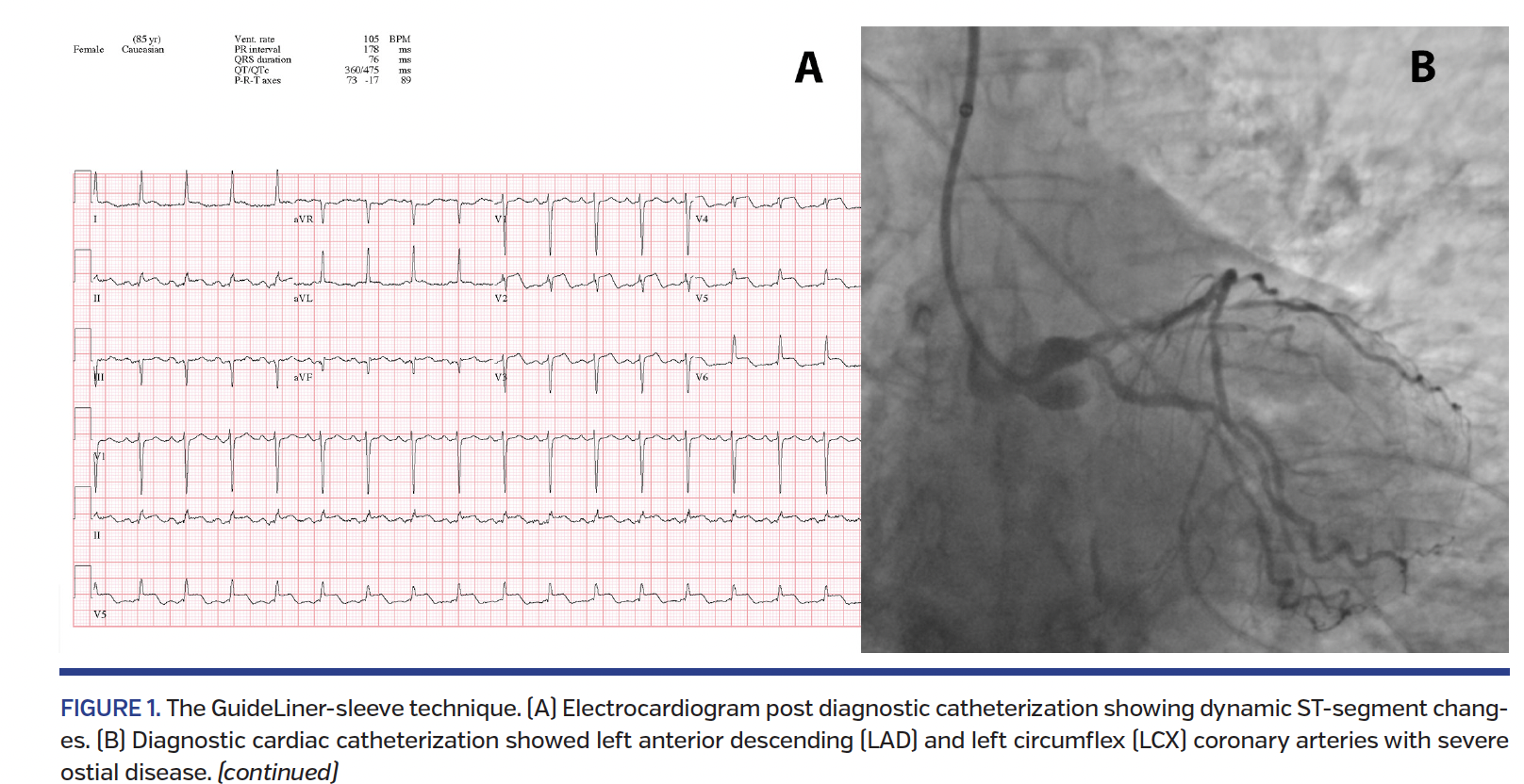 FIGURE 1. The GuideLiner-sleeve technique..png