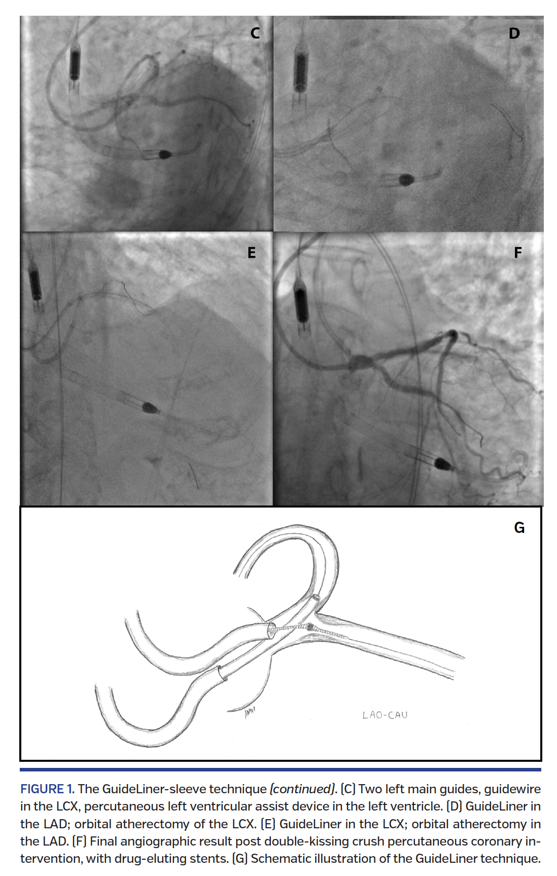FIGURE 1. The GuideLiner-sleeve technique.png