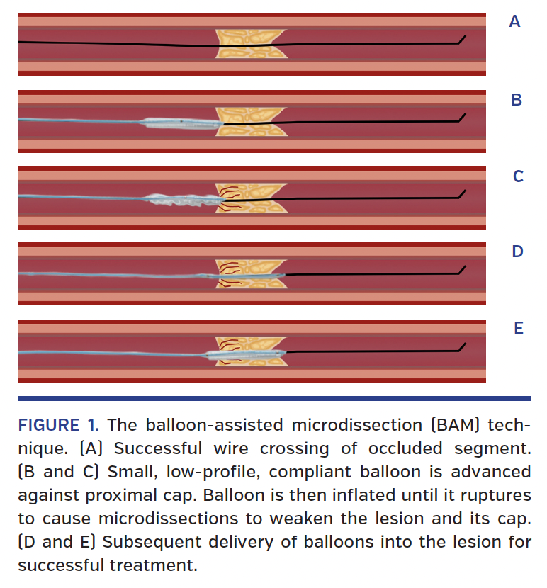 FIGURE 1. The balloon-assisted microdissection.png