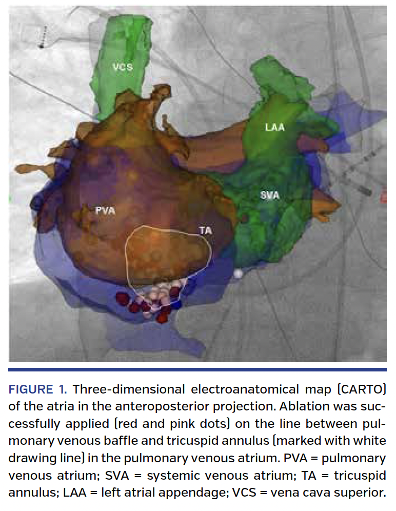 FIGURE 1. Three-dimensional electroanatomical map
