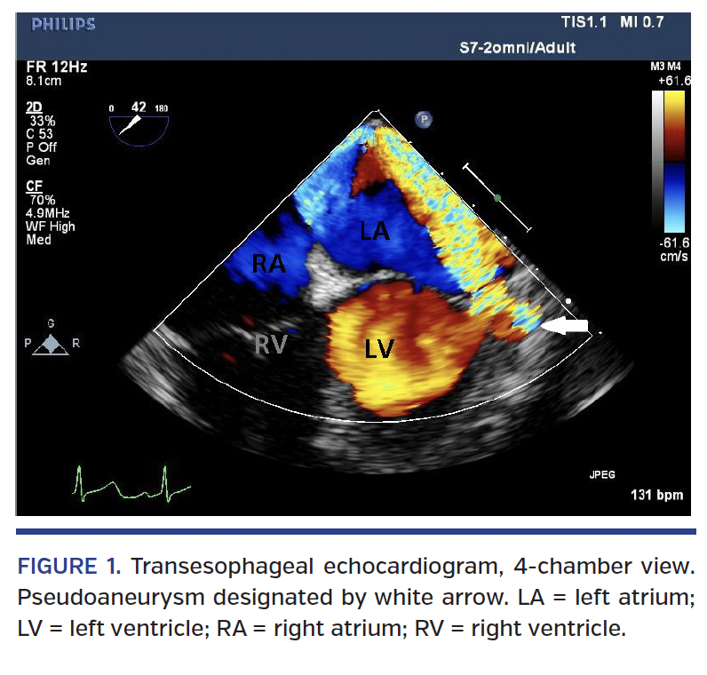 FIGURE 1. Transesophageal echocardiogram,.png