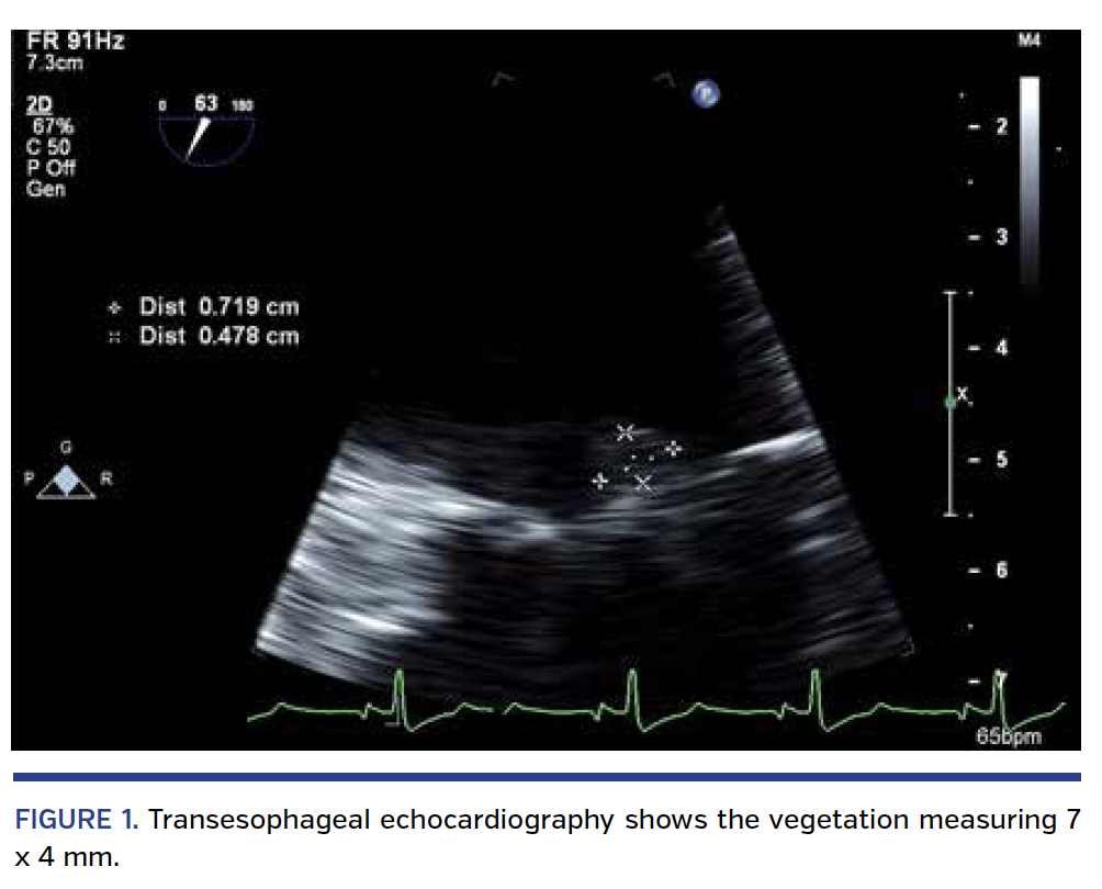 FIGURE 1. Transesophageal echocardiography.png