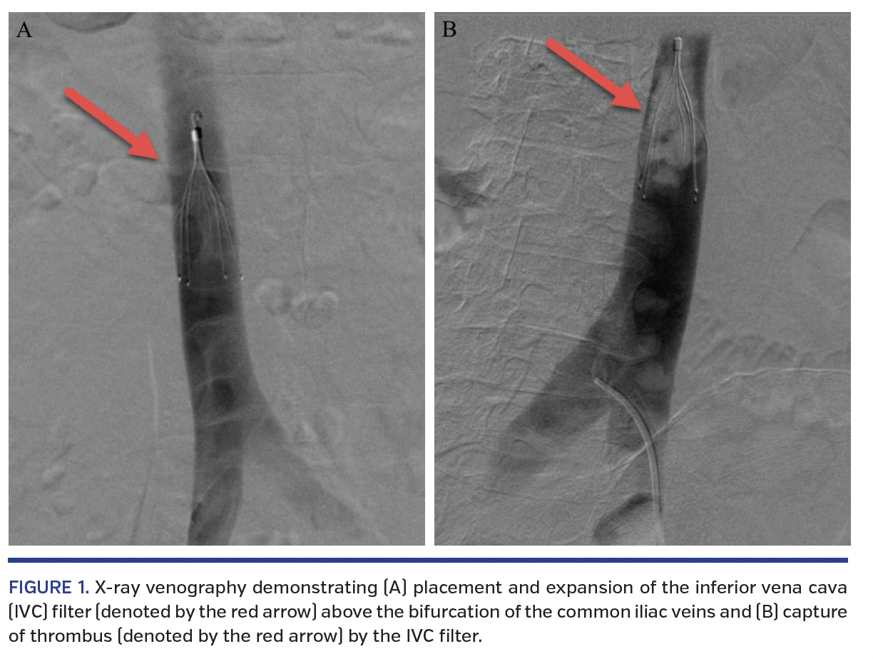 FIGURE 1. X-ray venography.png