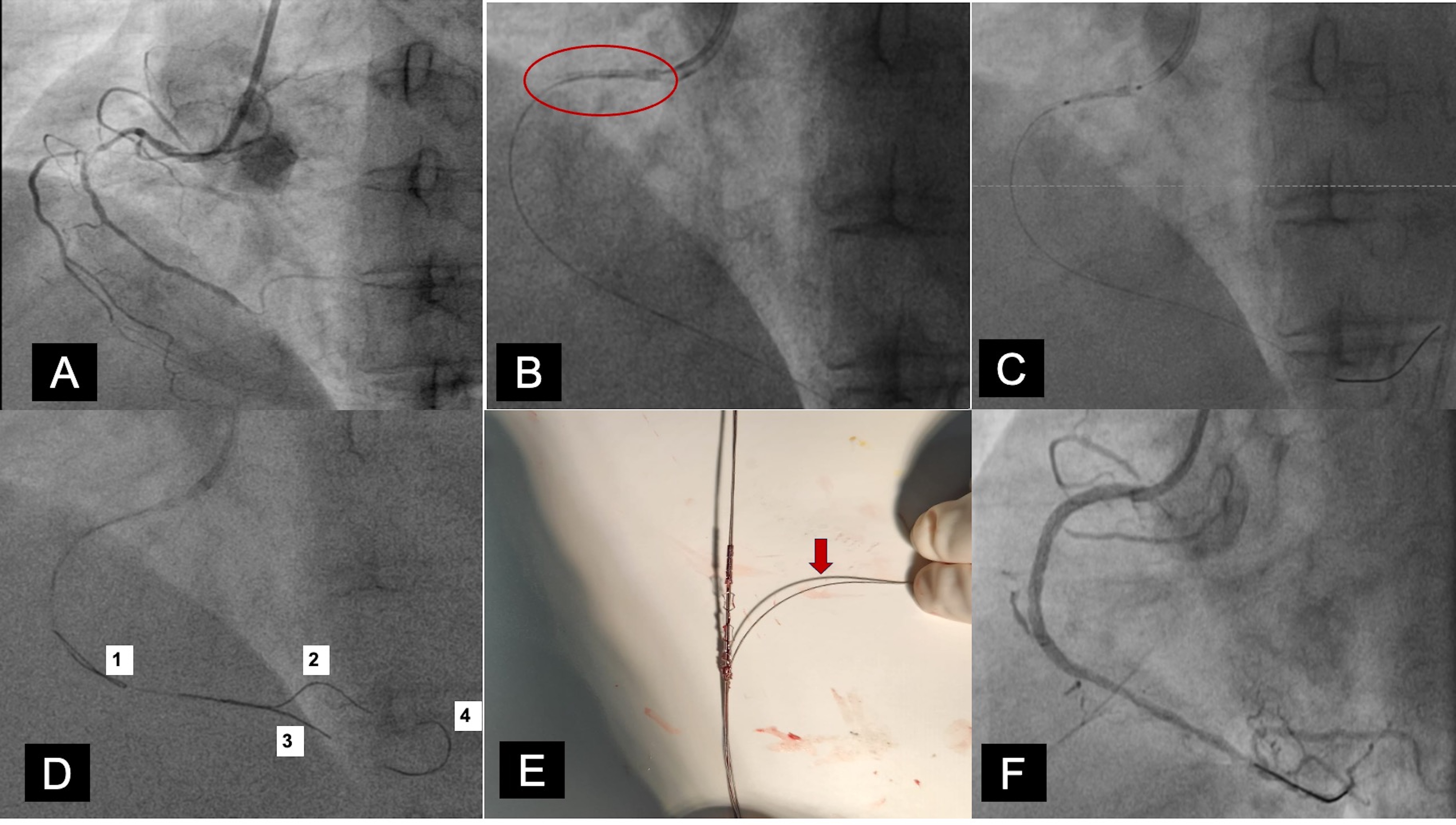 Figure. Coronary angiogram