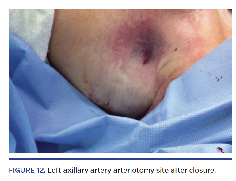 FIGURE 12. Left axillary artery arteriotomy site after closure..png