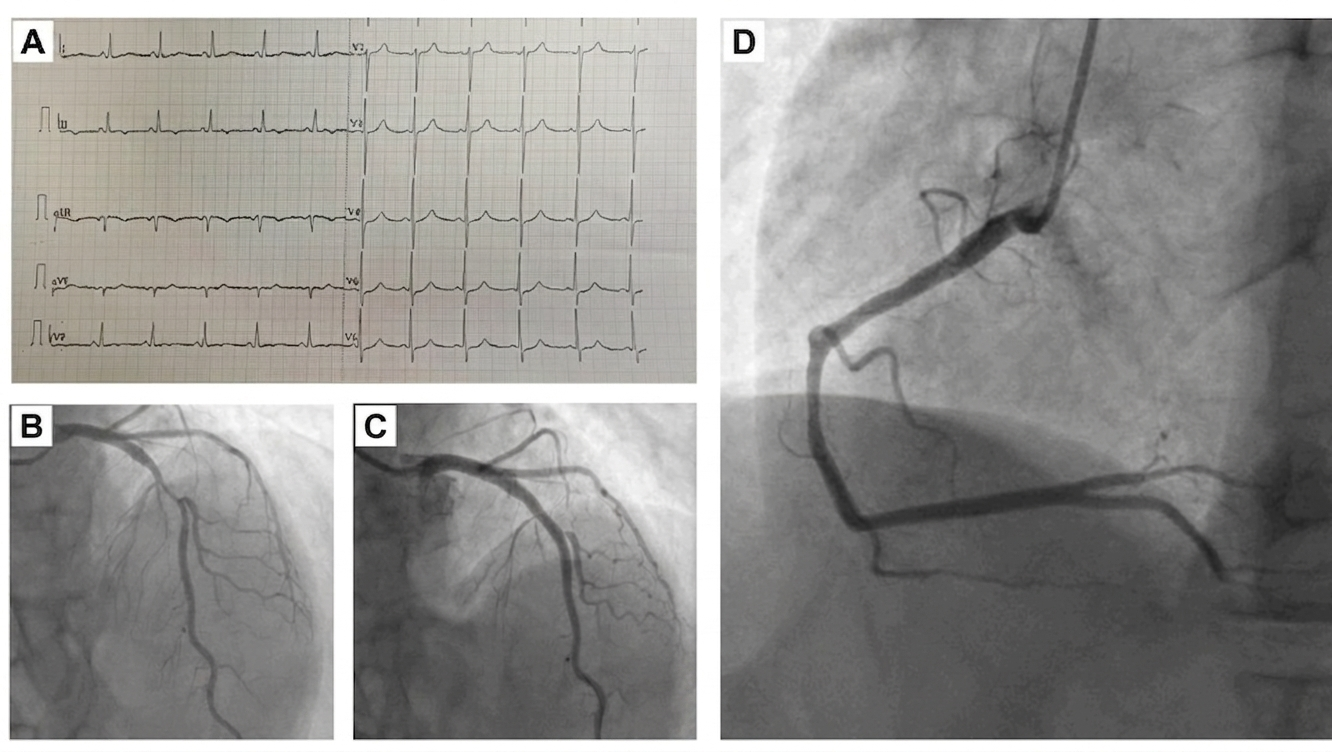 Figure 1. (A) Baseline normal electrocardiogram