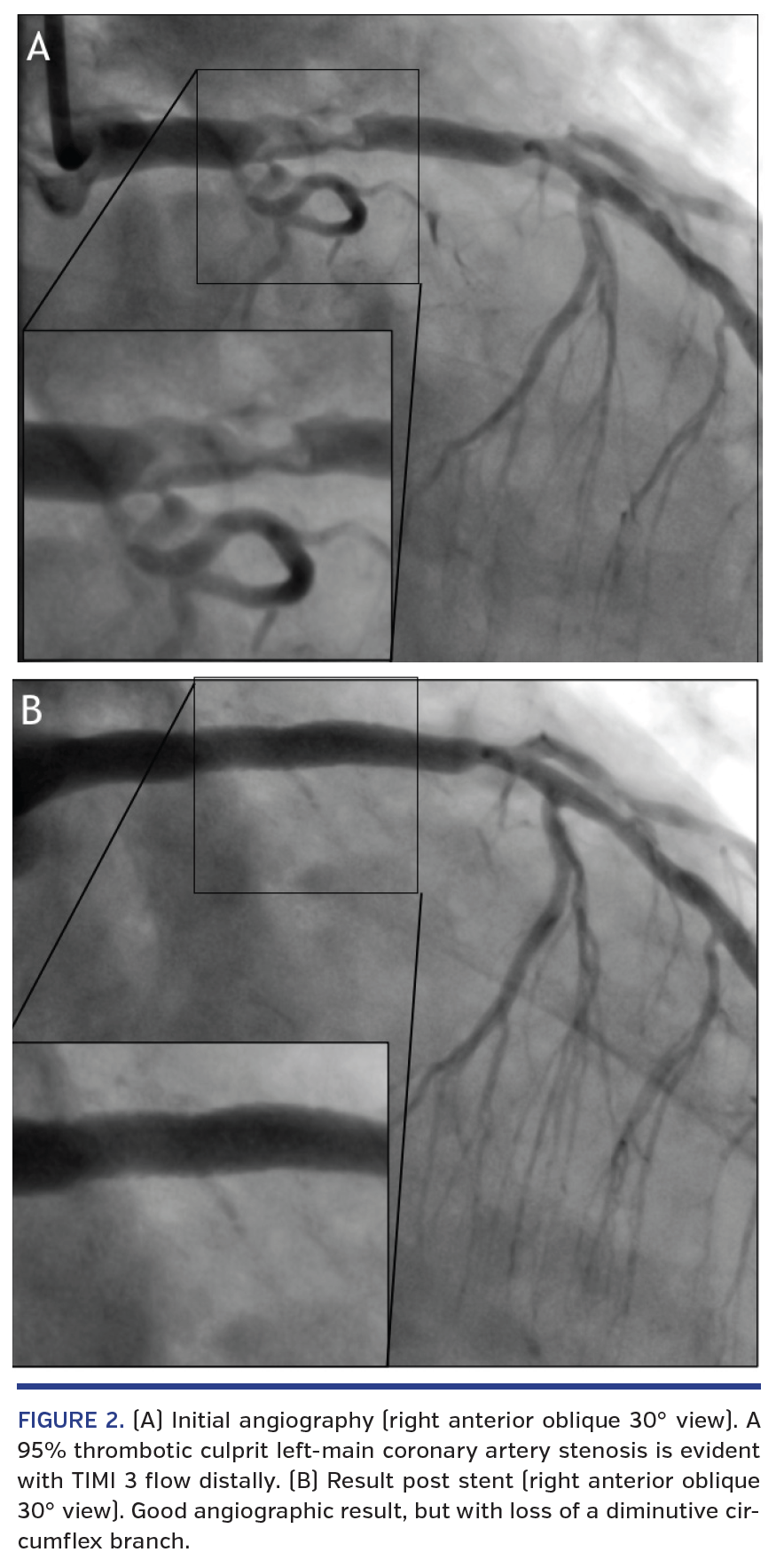 FIGURE 2. (A) Initial angiography.png