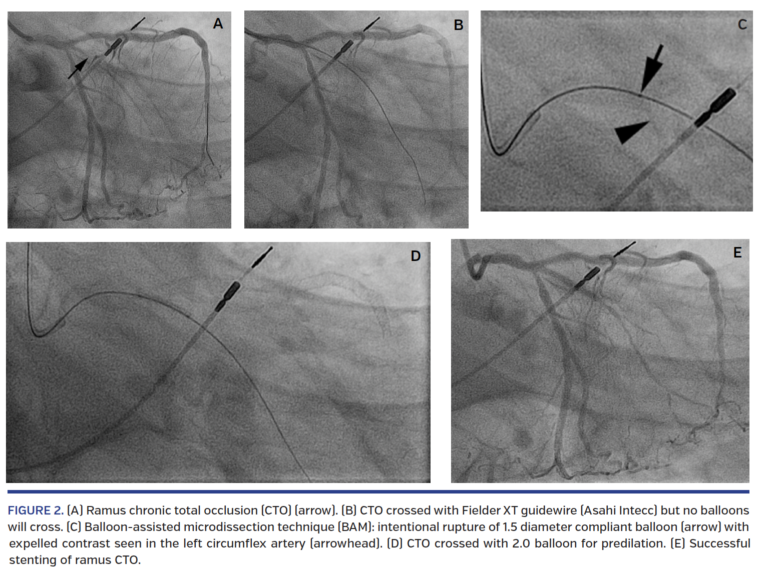 FIGURE 2. (A) Ramus chronic total occlusion.png