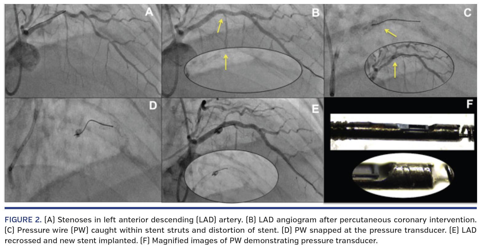 FIGURE 2. (A) Stenoses in left anterior descending (LAD) artery..png