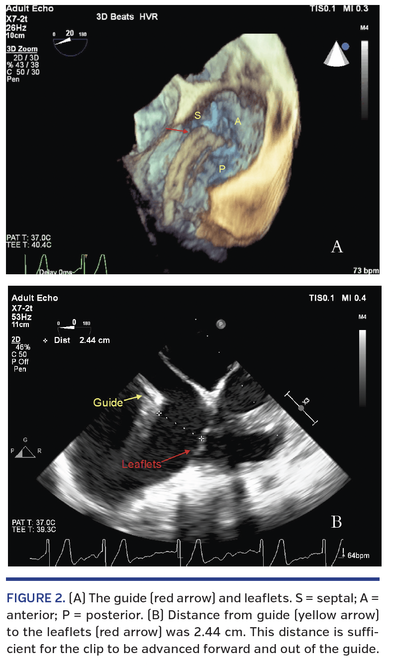 FIGURE 2. (A) The guide (red arrow) and leaflets..png