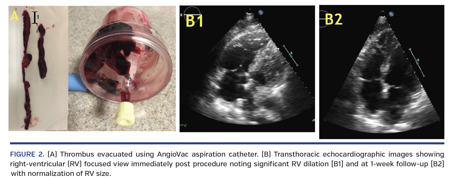 FIGURE 2. (A) Thrombus evacuated using AngioVac aspiration catheter..png