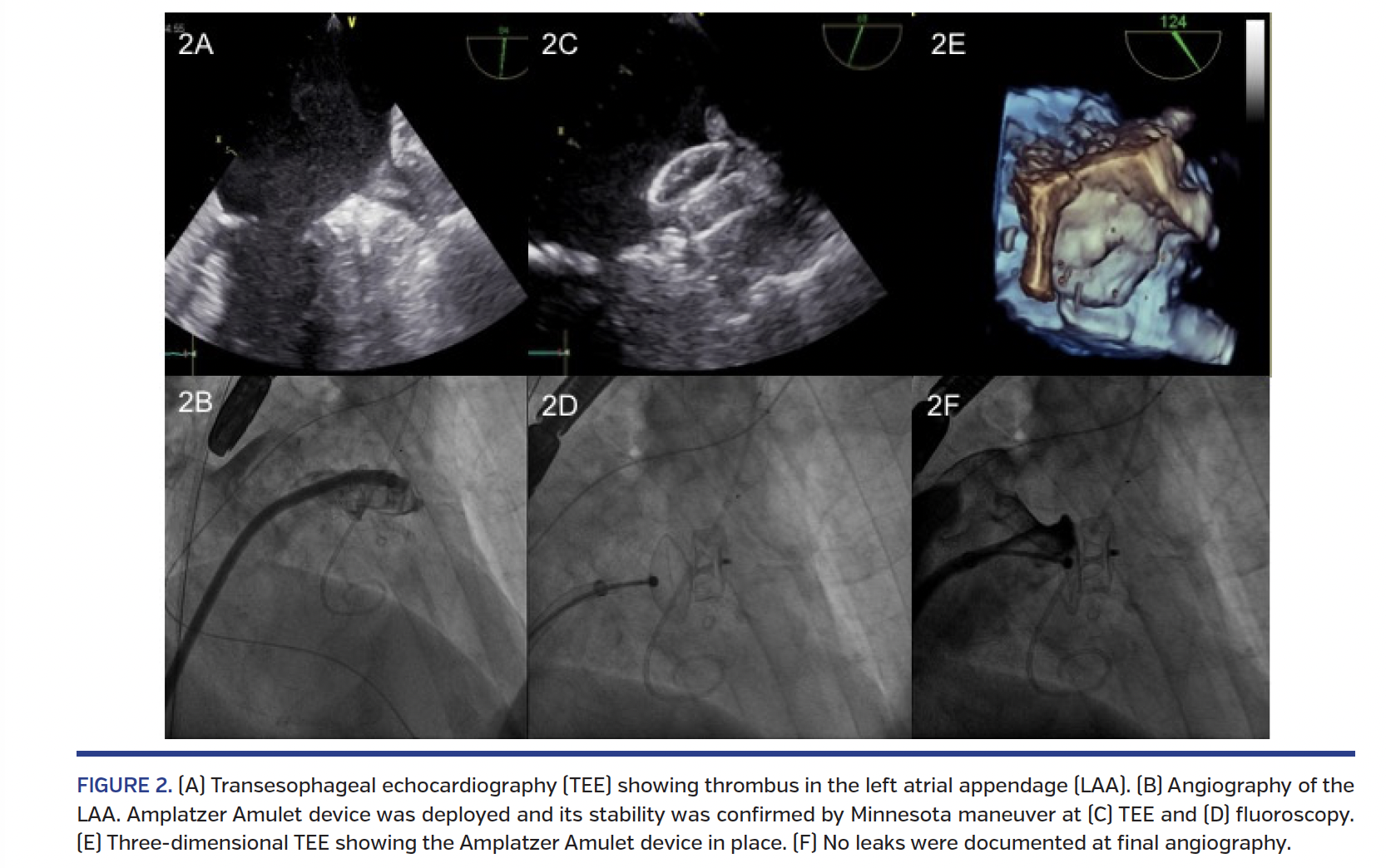 FIGURE 2. (A) Transesophageal echocardiography.png