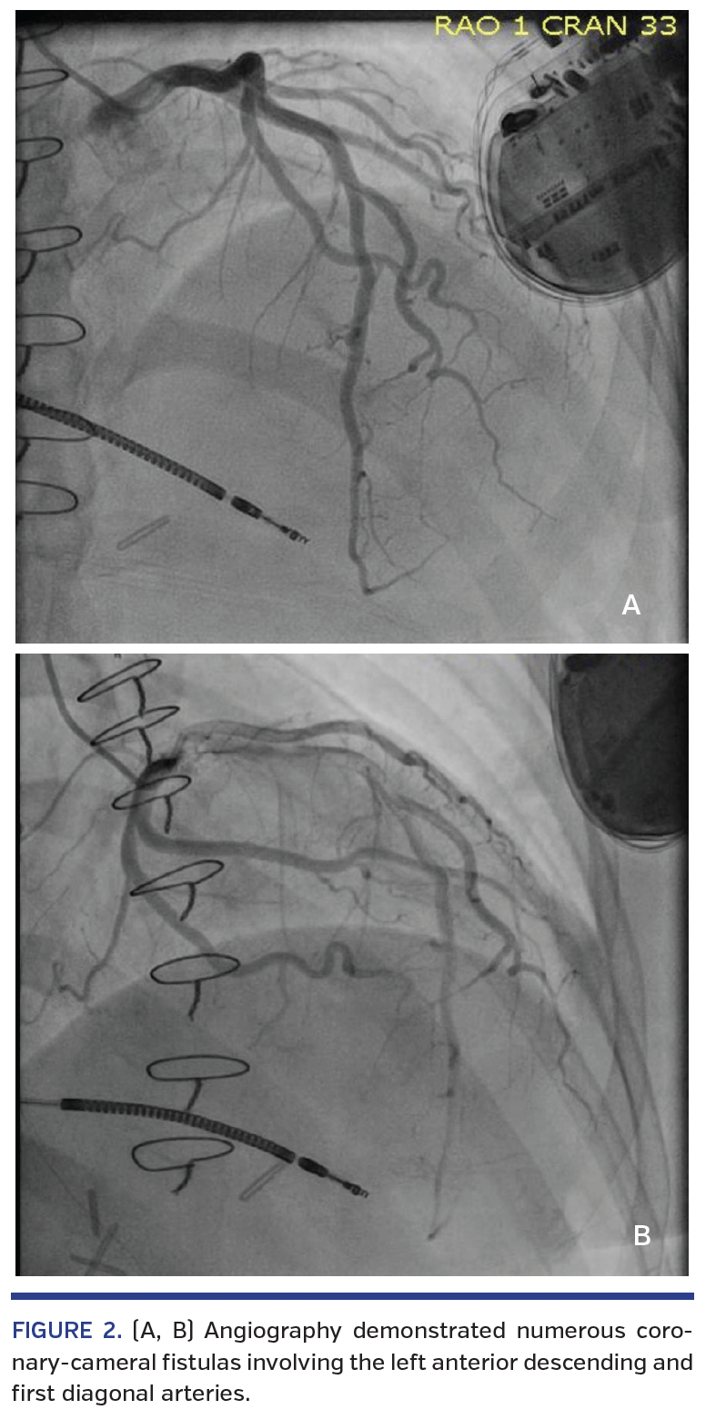 FIGURE 2. (A, B) Angiography.png