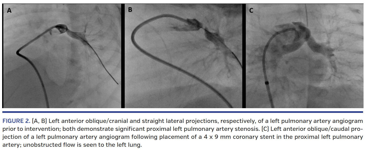 xFIGURE 2. (A, B) Left anterior oblique/cranial and straight lateral projections,.png