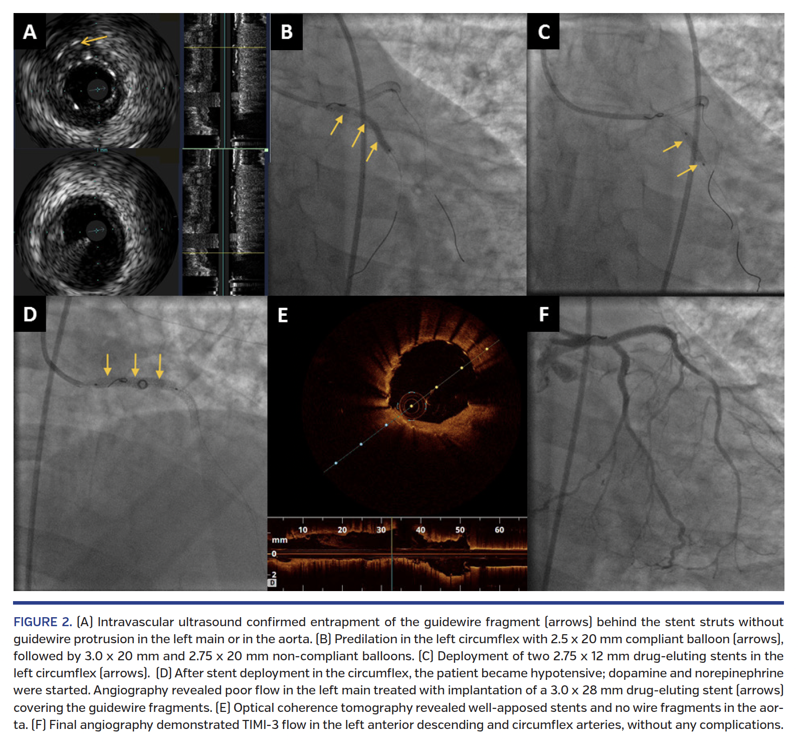 Management of Guidewire Entrapment With Laser Atherectomy