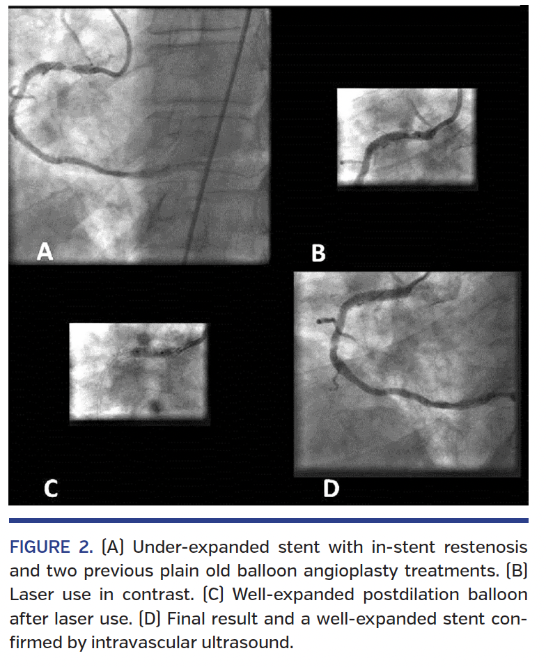 Excimer Laser With and Without Contrast for the Management of Under ...