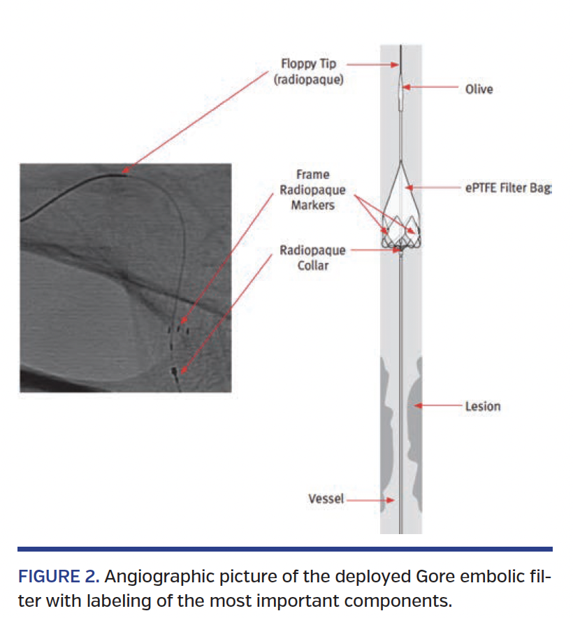 FIGURE 2. Angiographic picture.png