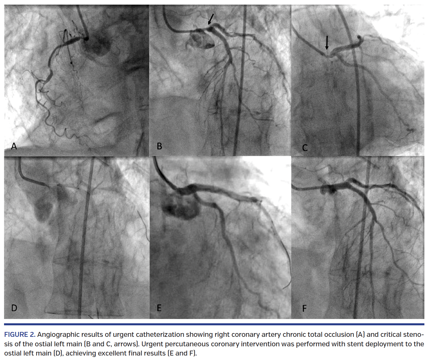 FIGURE 2. Angiographic results of urgent catheterization showing right coronary artery chronic total occlusion.png