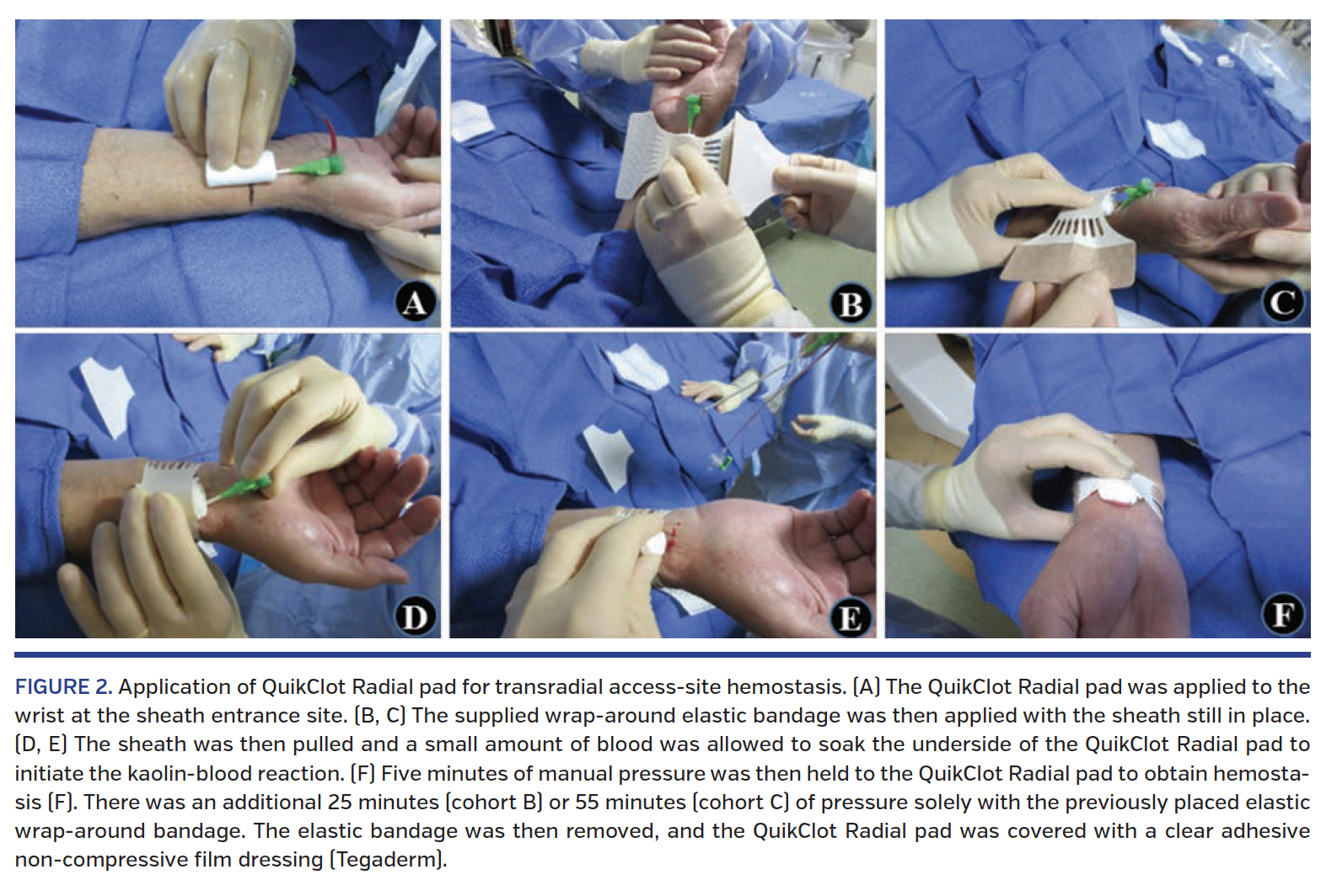 FIGURE 2. Application of QuikClot Radial pad.png