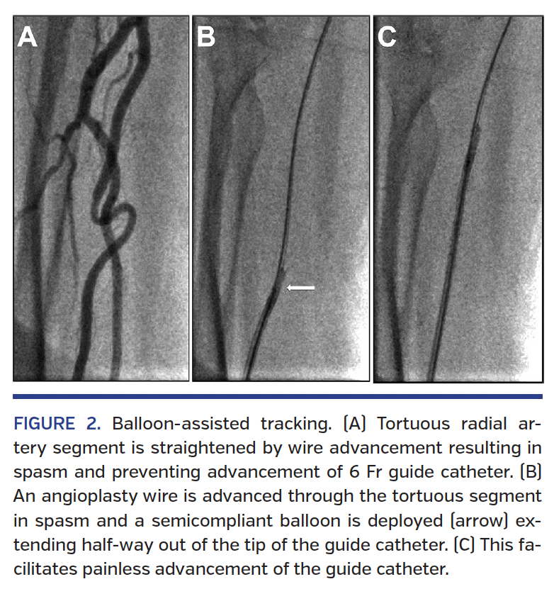 FIGURE 2. Balloon-assisted tracking..png