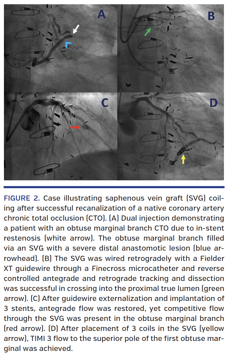 FIGURE 2. Case illustrating saphenous vein graft.png