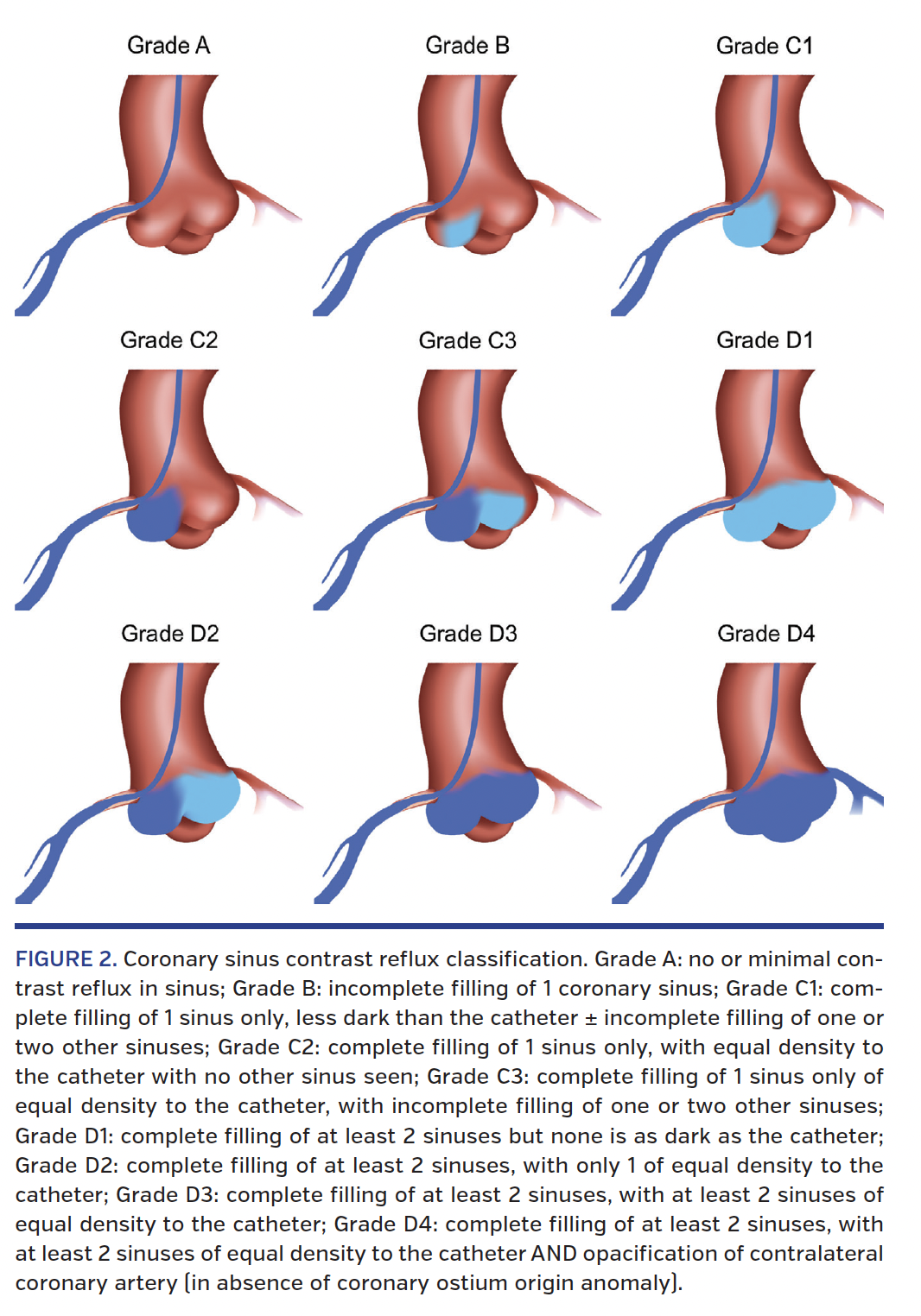 FIGURE 2. Coronary sinus contrast reflux classification..png