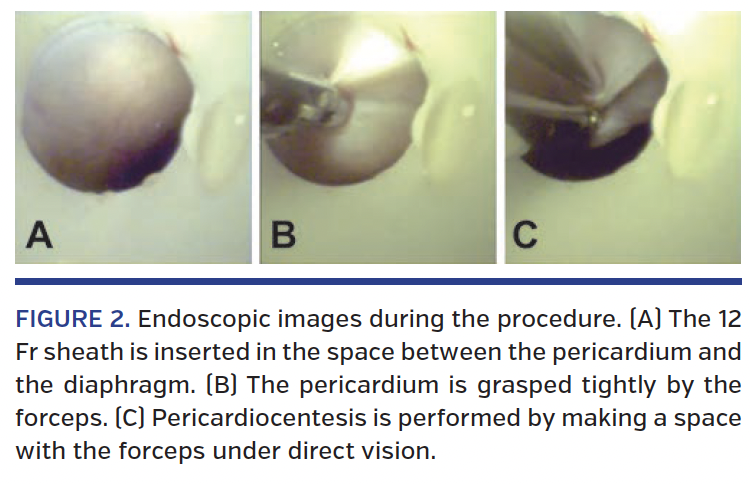FIGURE 2. Endoscopic images during the procedure..png