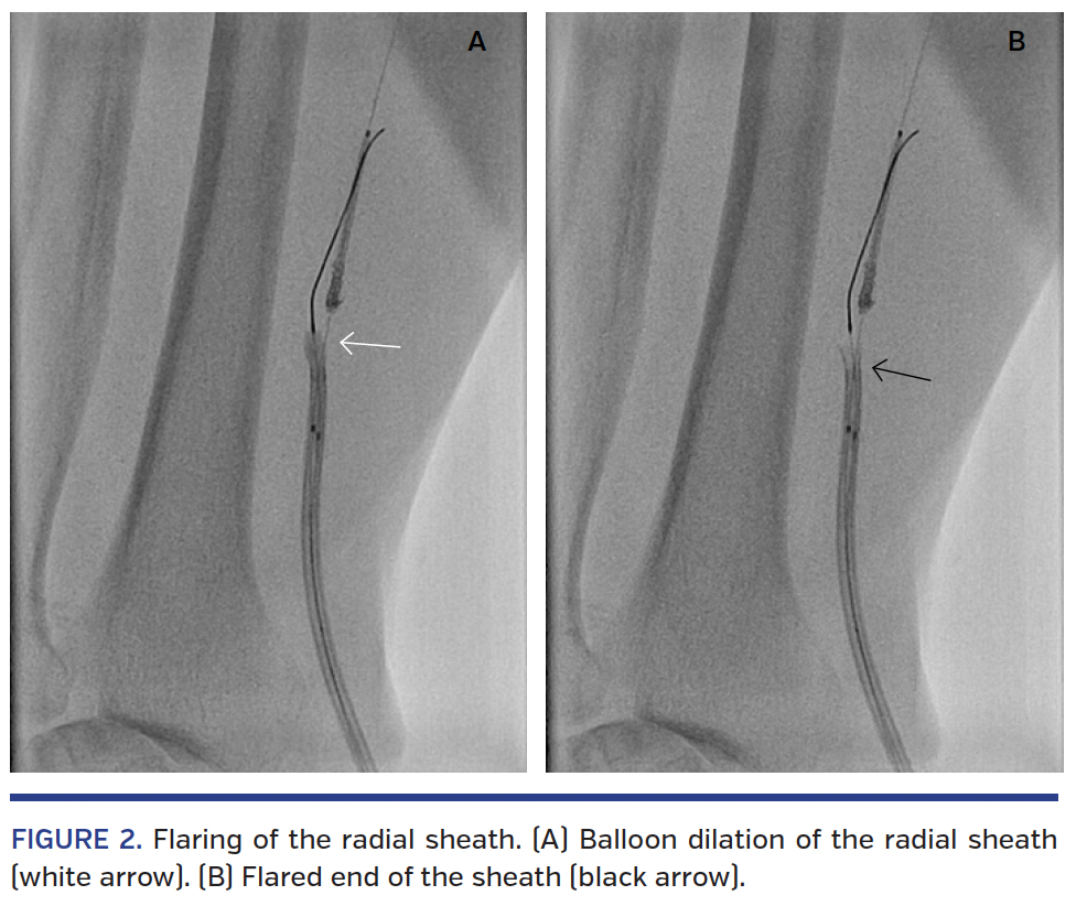 FIGURE 2. Flaring of the radial sheath..png