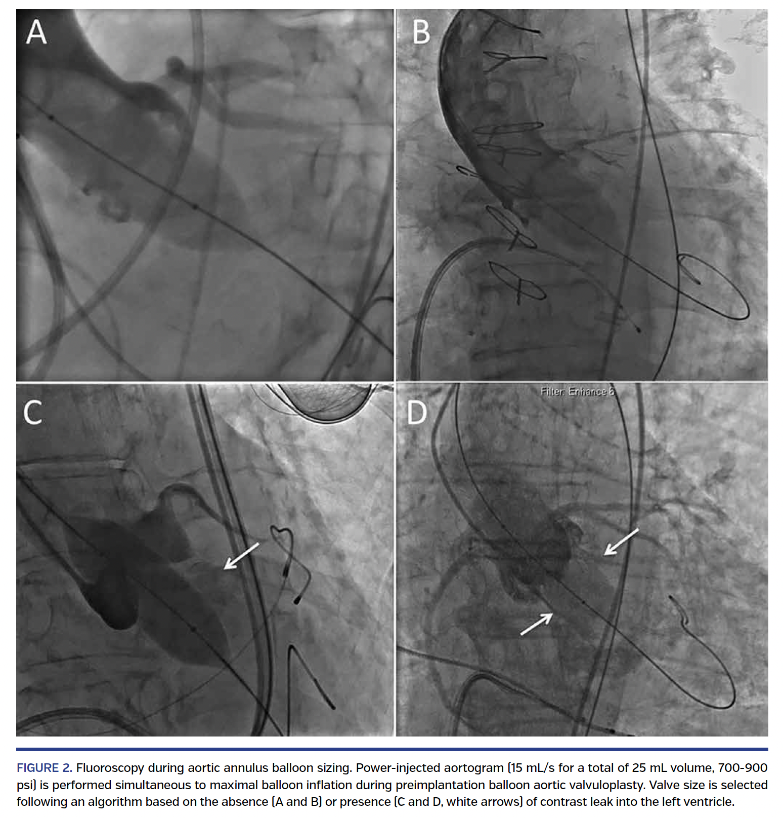 FIGURE 2. Fluoroscopy during aortic annulus.png