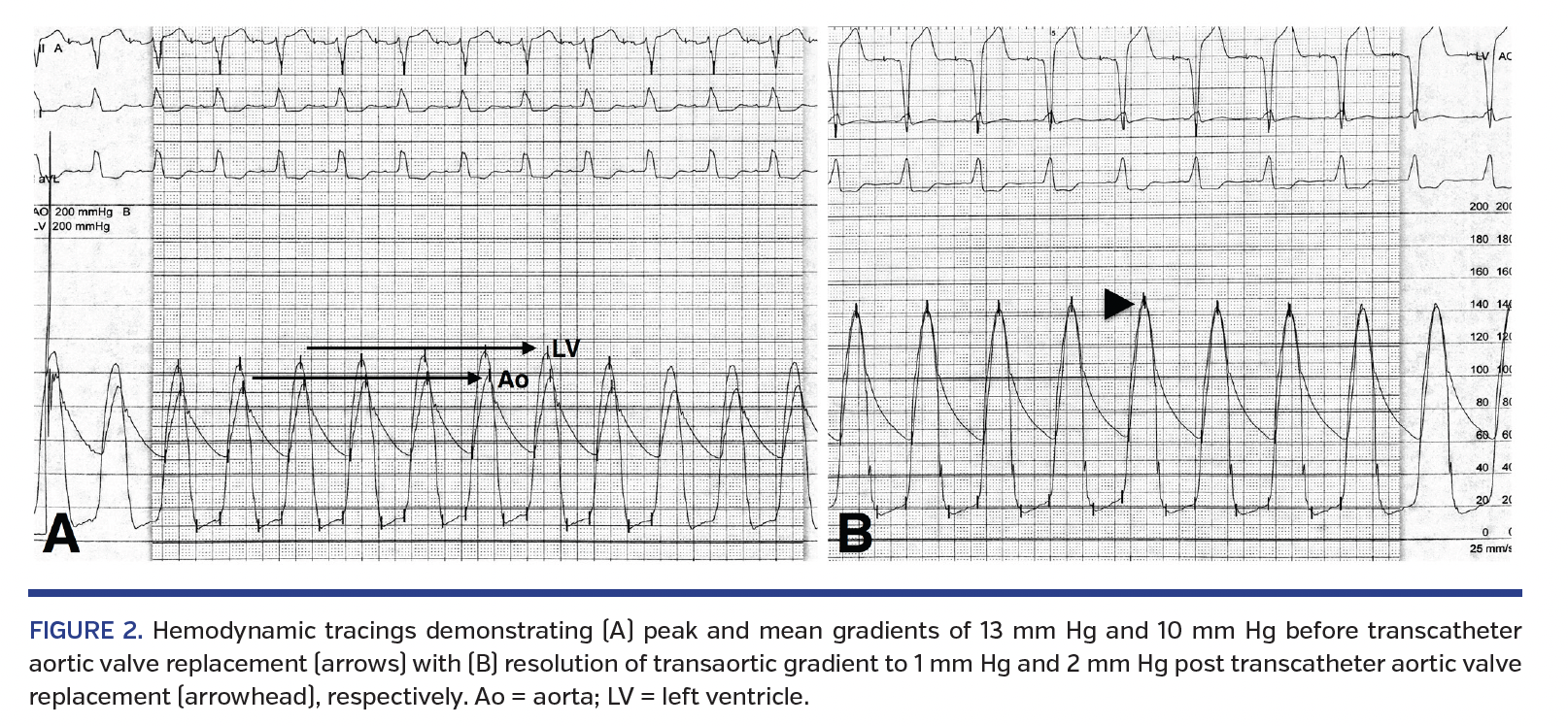 FIGURE 2. Hemodynamic tracings.png