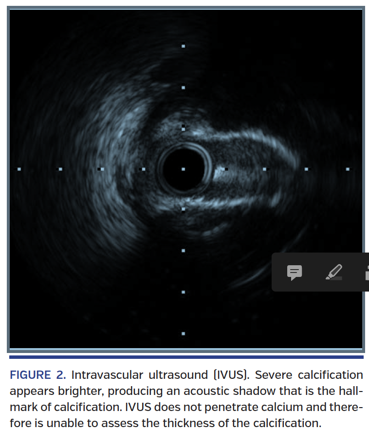 FIGURE 2. Intravascular ultrasound.png