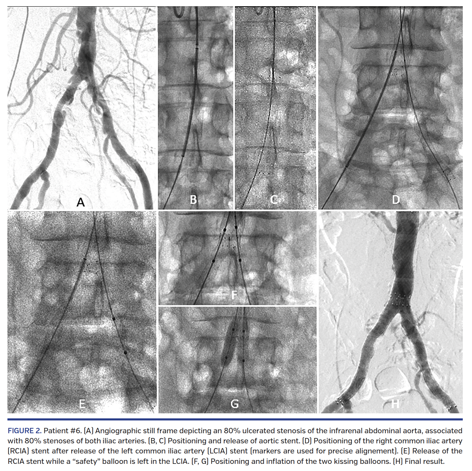 FIGURE 2. Patient #6. (A) Angiographic still frame.png