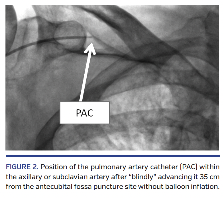 FIGURE 2. Position of the pulmonary artery catheter.png