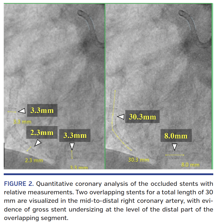 FIGURE 2. Quantitative coronary analysis.png