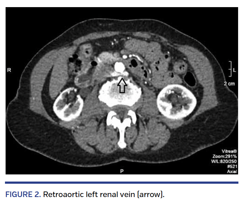FIGURE 2. Retroaortic left renal vein (arrow)..png
